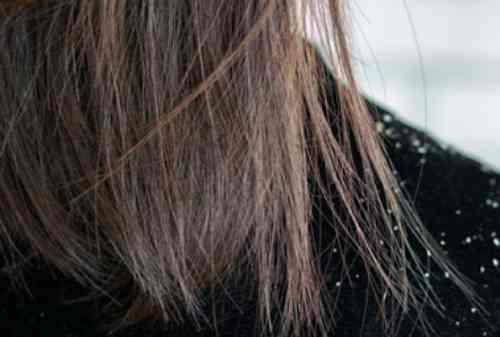 Penyebab Utama dan Cara Ampuh Menghilangkan Ketombe Di Rambut